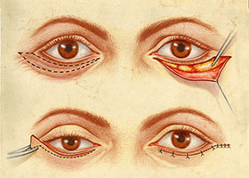 lower eyelid surgery tunisia